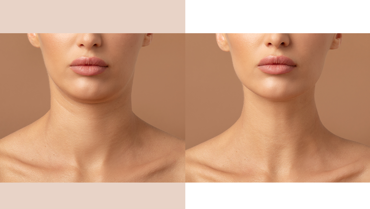 Ablative Vs. Non-ablative Laser Skin Resurfacing: Which is Right for You?