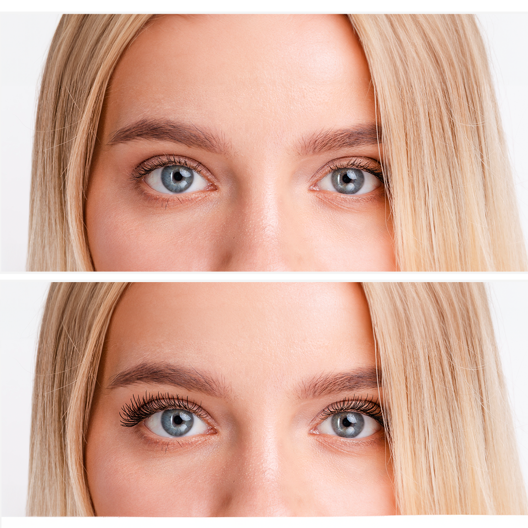 At Home Eye Lift Before and After Gallery: The Real Results