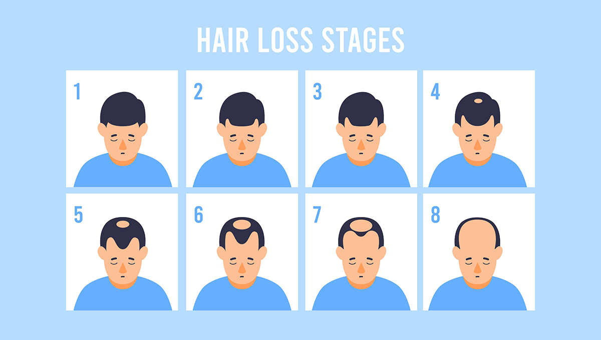 Image pour la requête Is there a way to prevent hair Loss?