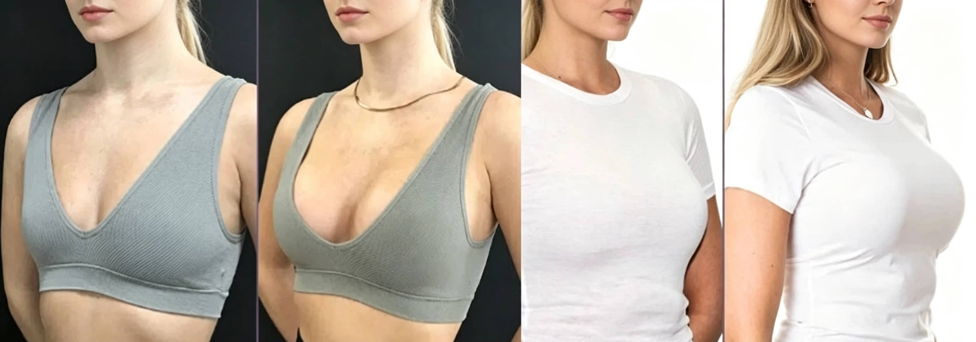 breast enlargement pump before and after results after 6 months