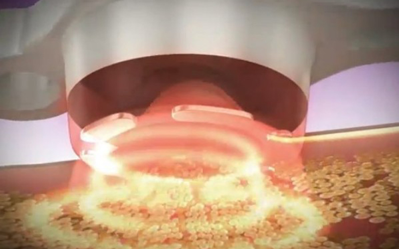 which is better rf or cavitation